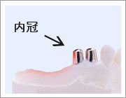 自然な着け心地の入れ歯1